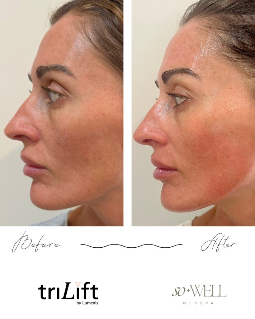 TriLift before and after, side profile